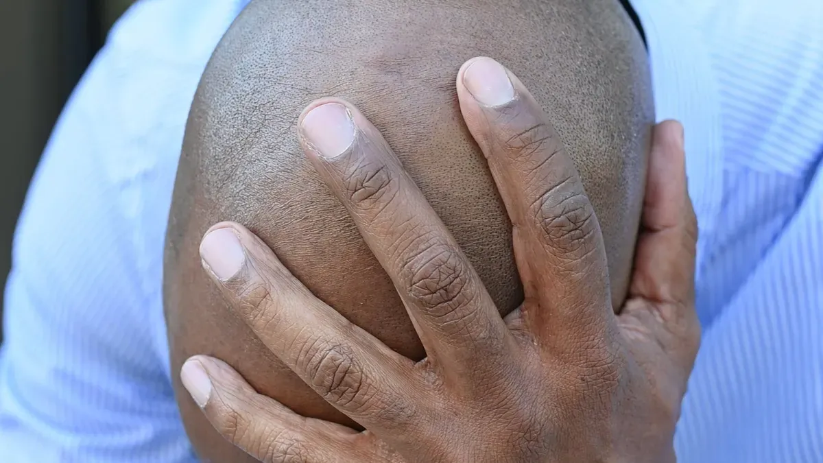 ما هو الفرق بين أقطار لكمة FUE المختلفة؟